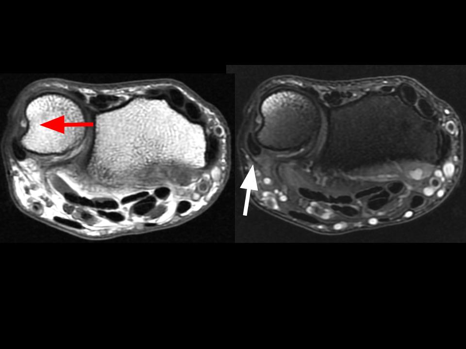 Figure 1 for case extensor carpi ulnaris tendon ( RID2382 )